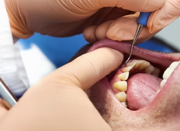 Periodontal Surgery